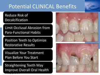 Potential CLINICAL Benefits
Reduce Risk of
Decalcification
Position Teeth to Optimize
Restorative Results
Limit Occlusal Abrasion from
Para-Functional Habits
Visualize Your Treatment
Plan Before You Start
Straightening Teeth May
Improve Overall Oral Health
 