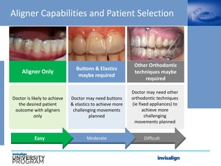 Difficult
Moderate
Aligner Capabilities and Patient Selection
Aligner Only
Doctor is likely to achieve
the desired patient
outcome with aligners
only
Buttons & Elastics
maybe required
Doctor may need buttons
& elastics to achieve more
challenging movements
planned
Doctor may need other
orthodontic techniques
(ie fixed appliances) to
achieve more
challenging
movements planned
Other Orthodontic
techniques maybe
required
Easy
 