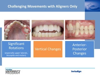 Challenging Movements with Aligners Only
Significant
Rotations
(especially upper laterals,
bicuspids and molars)
Vertical Changes
Anterior-
Posterior
Changes
 