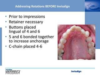 • Prior to impressions
• Retainer necessary
• Buttons placed
lingual of 4 and 6
• 5 and 6 bonded together
to increase anchorage
• C-chain placed 4-6
Addressing Rotations BEFORE Invisalign
 