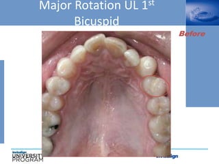 Major Rotation UL 1st
Bicuspid
Before
 