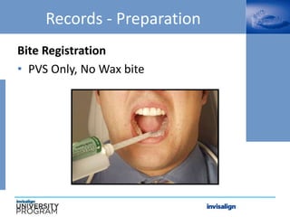 Bite Registration
• PVS Only, No Wax bite
Records - Preparation
 