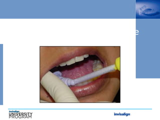 PVS Bite Registration Technique
 