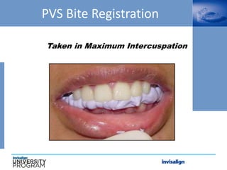PVS Bite Registration
Taken in Maximum Intercuspation
 