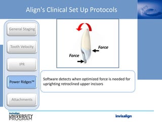 Software detects when optimized force is needed for
uprighting retroclined upper incisors
Align's Clinical Set Up Protocols
General Staging
Tooth Velocity
IPR
Power Ridges™
Attachments
Force
Force
 