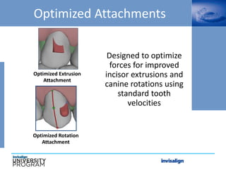 Optimized Attachments
Optimized Extrusion
Attachment
Optimized Rotation
Attachment
Designed to optimize
forces for improved
incisor extrusions and
canine rotations using
standard tooth
velocities
 