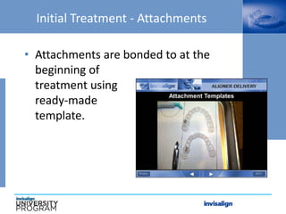 Initial Treatment - Attachments
• Attachments are bonded to at the
beginning of
treatment using
ready-made
template.
 