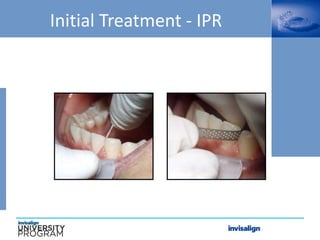 Initial Treatment - IPR
 