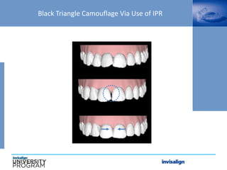 Black Triangle Camouflage Via Use of IPR
 