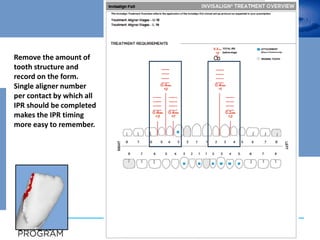 Remove the amount of
tooth structure and
record on the form.
Single aligner number
per contact by which all
IPR should be completed
makes the IPR timing
more easy to remember.
 