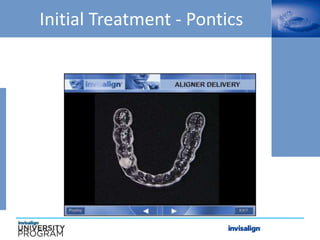 Initial Treatment - Pontics
 