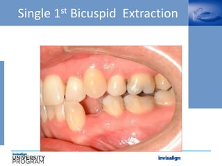 Single 1st Bicuspid Extraction
 