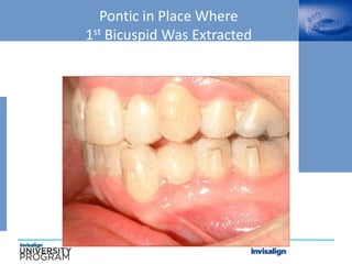 Pontic in Place Where
1st Bicuspid Was Extracted
 