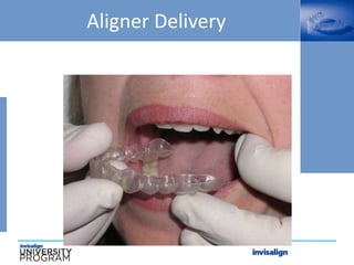 Aligner Delivery
 