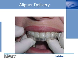 Aligner Delivery
 