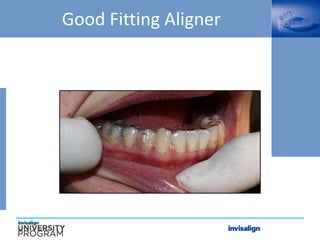 Good Fitting Aligner
 