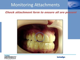 Monitoring Attachments
Check attachment form to ensure all are present
 