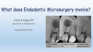 What does Endodontic Microsurgery involve?
Julie K Kilgariff
Specialist in Endodontics
www.julie4endo.com
Previous failed
surgery
Day surgical revision
done
15 months after
surgical revision
JKK JKK JKK
 