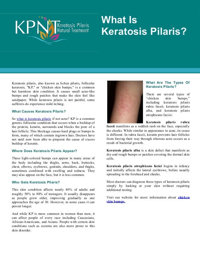 What Is Keratosis Pilaris