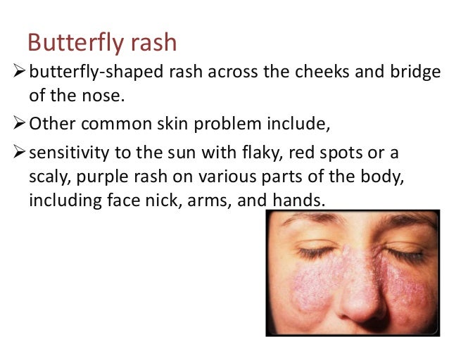 What causes a butterfly-shaped skin rash in people with lupus?