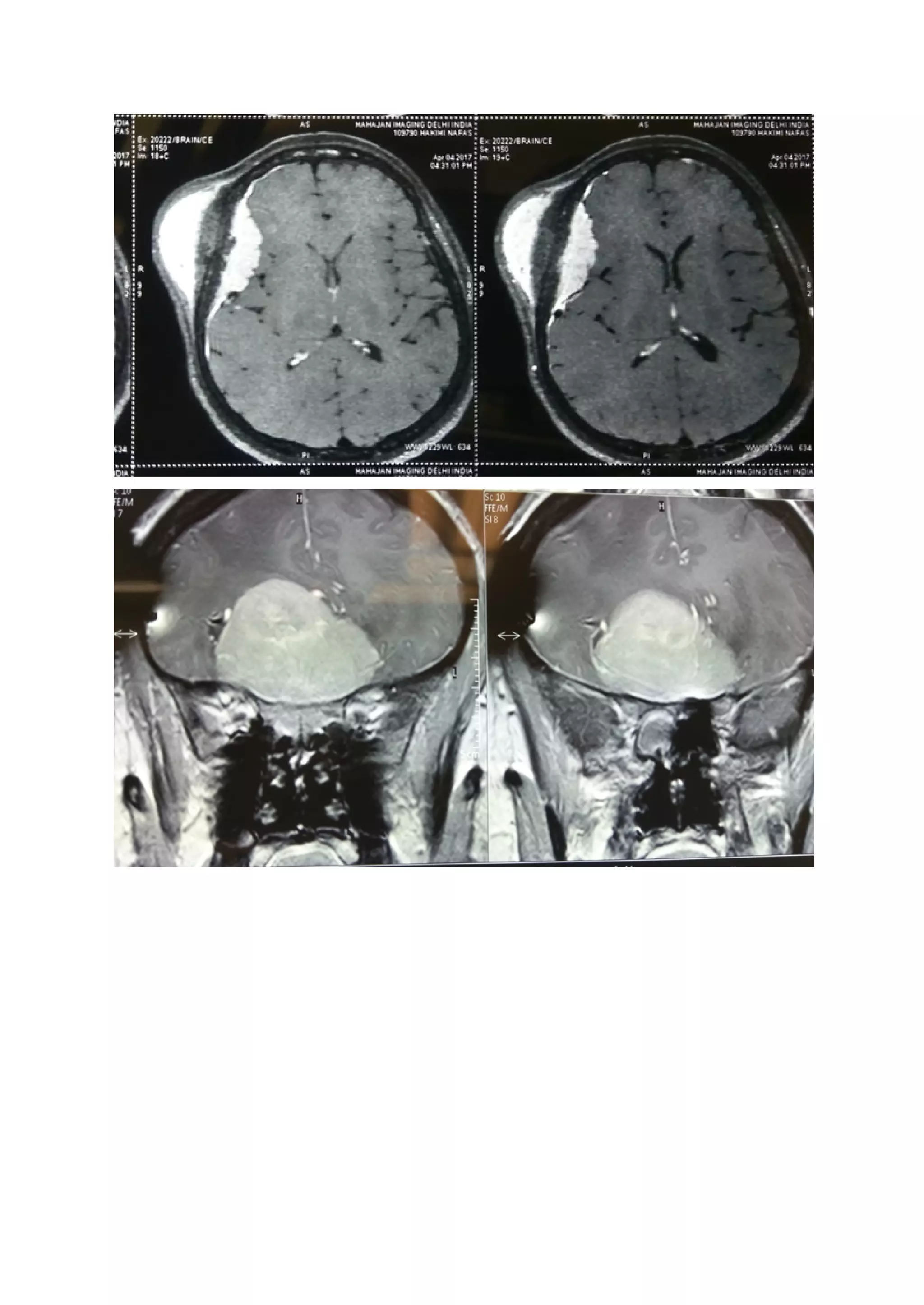 What Is Meningioma Pdf pdf what-is-meningioma-pdf-pdf