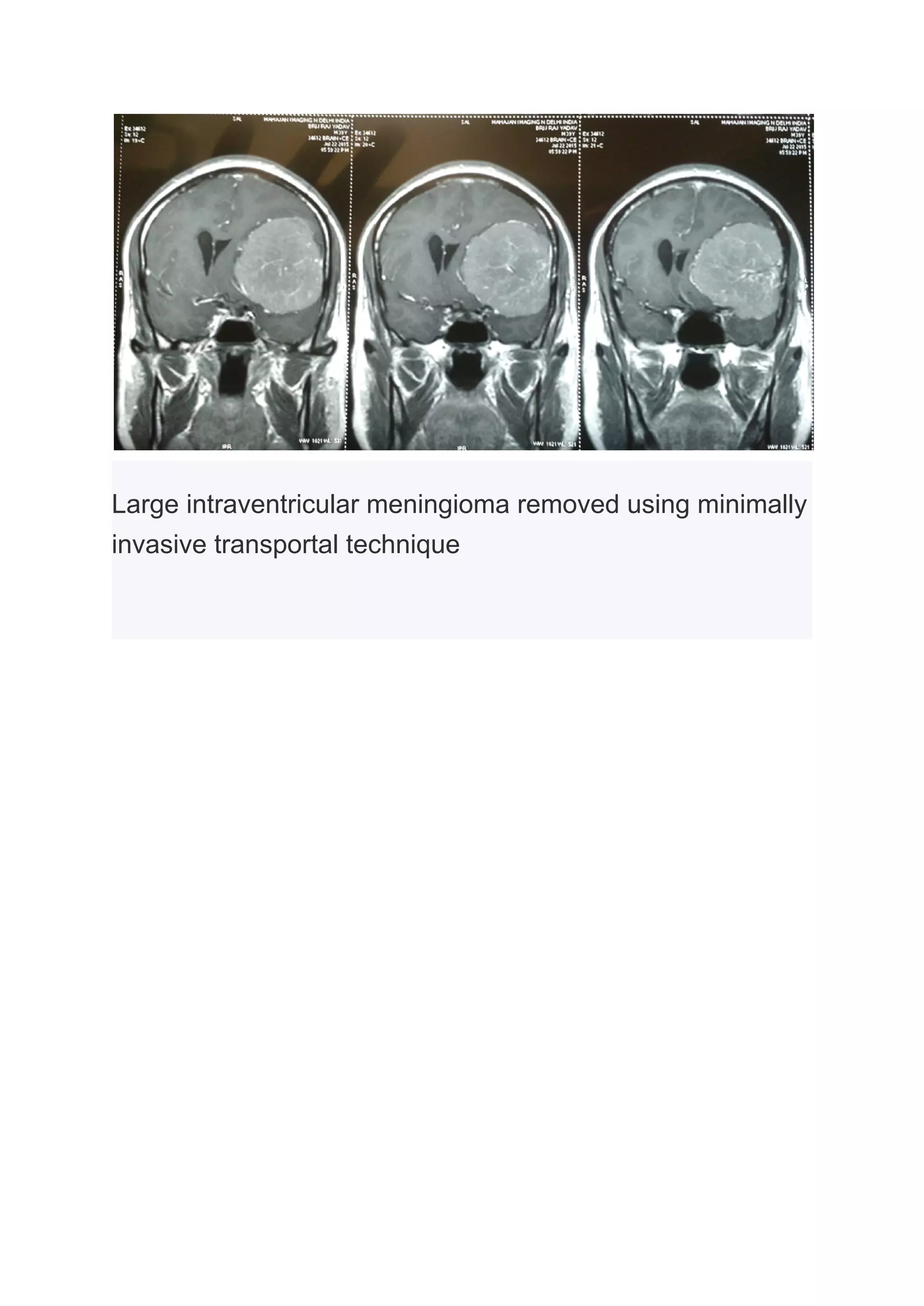 What Is Meningioma Pdf pdf what-is-meningioma-pdf-pdf