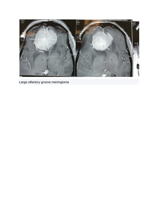 Large olfactory groove meningioma
 