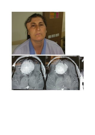 What is Meningioma pdf.pdf