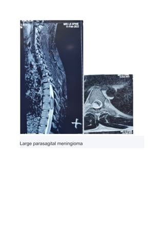 Large parasagital meningioma
 
