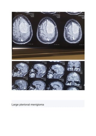 Large pterional menigioma
 