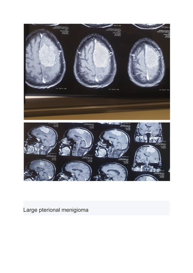 What Is Meningioma Pdf pdf what-is-meningioma-pdf-pdf