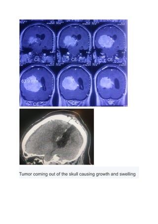 Tumor coming out of the skull causing growth and swelling
 