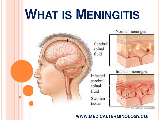 Image result for meningitis images