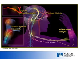 1-Peripheral
                              Trigeminal Sensitization   3-Forehead Allodynia




                2-Central Trigeminal
                Sensitization                                            4-Extracephalic
                                                                         Allodynia




Burstein R, et al. Brain. 2000.
 
