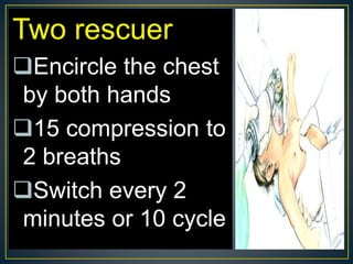 Two rescuer
Encircle the chest
by both hands
15 compression to
2 breaths
Switch every 2
minutes or 10 cycle
 
