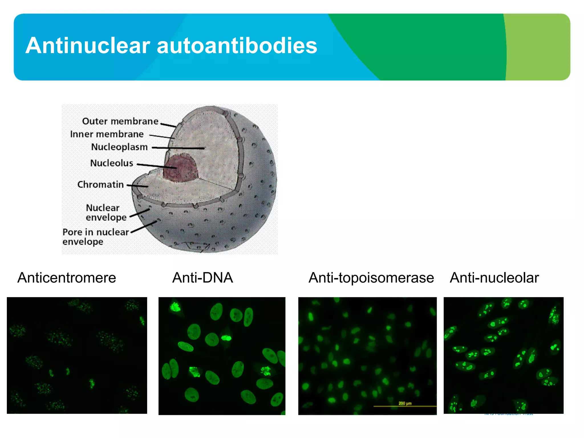 Antinuclear autoantibodies
Anticentromere Anti-DNA Anti-topoisomerase Anti-nucleolar
 