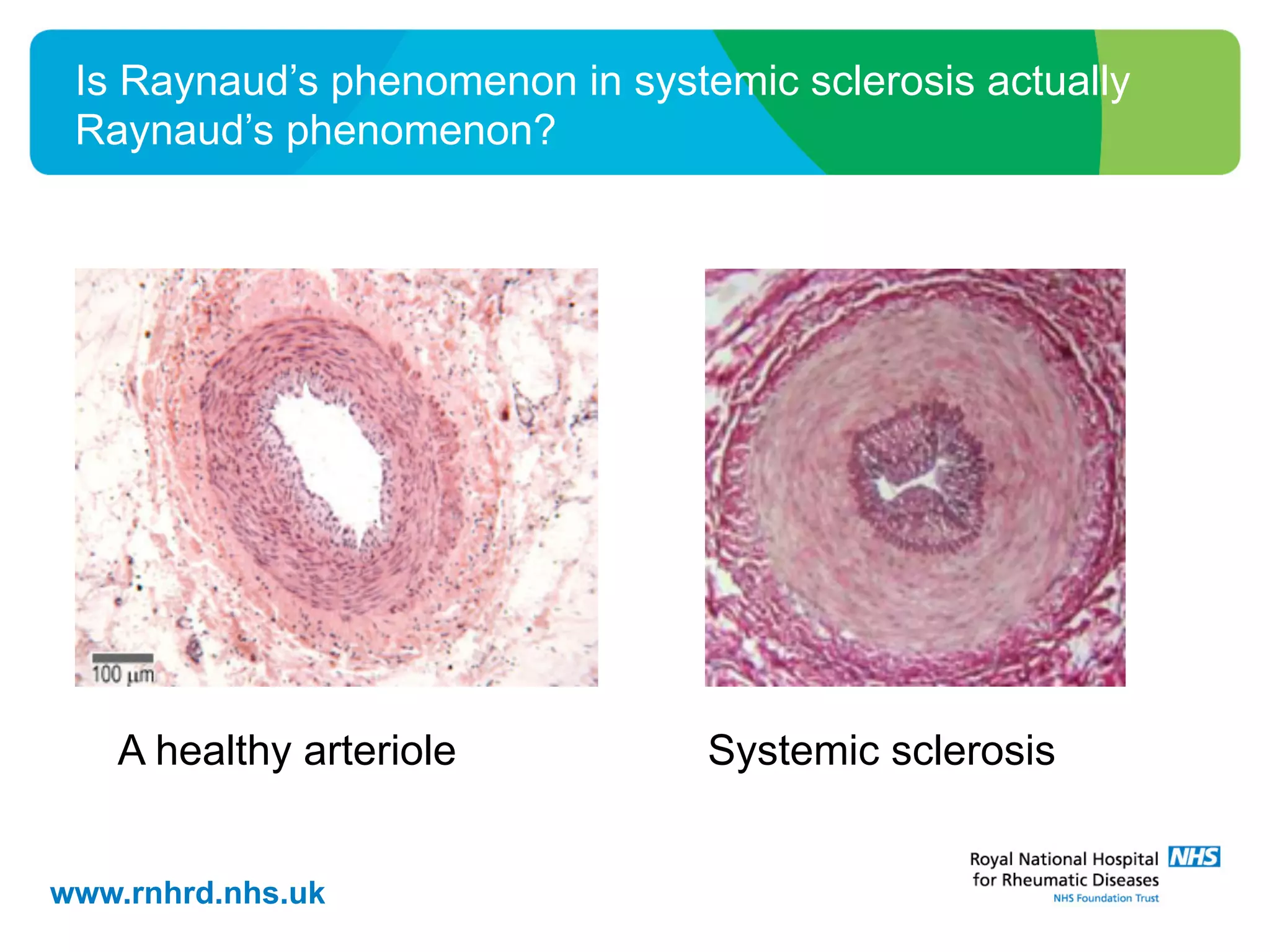 www.rnhrd.nhs.uk
Is Raynaud’s phenomenon in systemic sclerosis actually
Raynaud’s phenomenon?
A healthy arteriole Systemic sclerosis
 