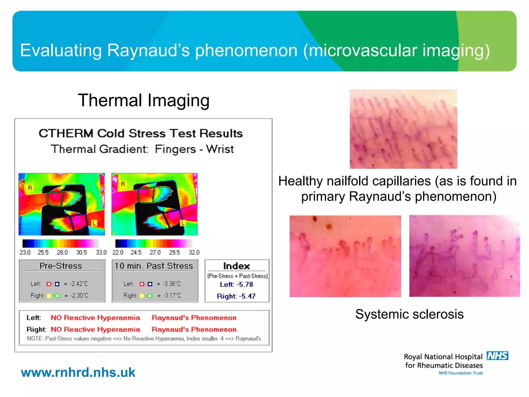 www.rnhrd.nhs.uk
Evaluating Raynaud’s phenomenon (microvascular imaging)
Thermal Imaging
Healthy nailfold capillaries (as is found in
primary Raynaud’s phenomenon)
Systemic sclerosis
 