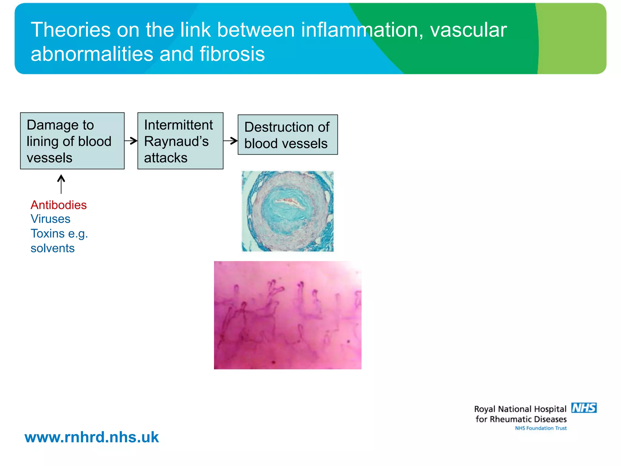 www.rnhrd.nhs.uk
Theories on the link between inflammation, vascular
abnormalities and fibrosis
Damage to
lining of blood
vessels
Intermittent
Raynaud’s
attacks
Destruction of
blood vessels
Antibodies
Viruses
Toxins e.g.
solvents
 