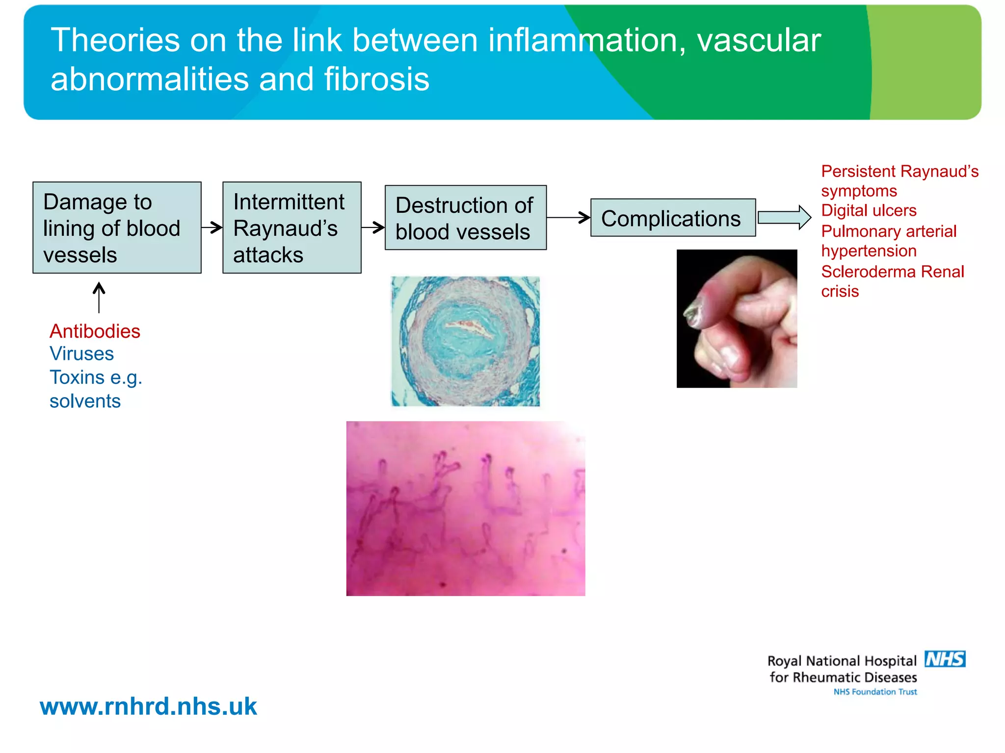 www.rnhrd.nhs.uk
Theories on the link between inflammation, vascular
abnormalities and fibrosis
Damage to
lining of blood
vessels
Intermittent
Raynaud’s
attacks
Complications
Destruction of
blood vessels
Antibodies
Viruses
Toxins e.g.
solvents
Persistent Raynaud’s
symptoms
Digital ulcers
Pulmonary arterial
hypertension
Scleroderma Renal
crisis
 