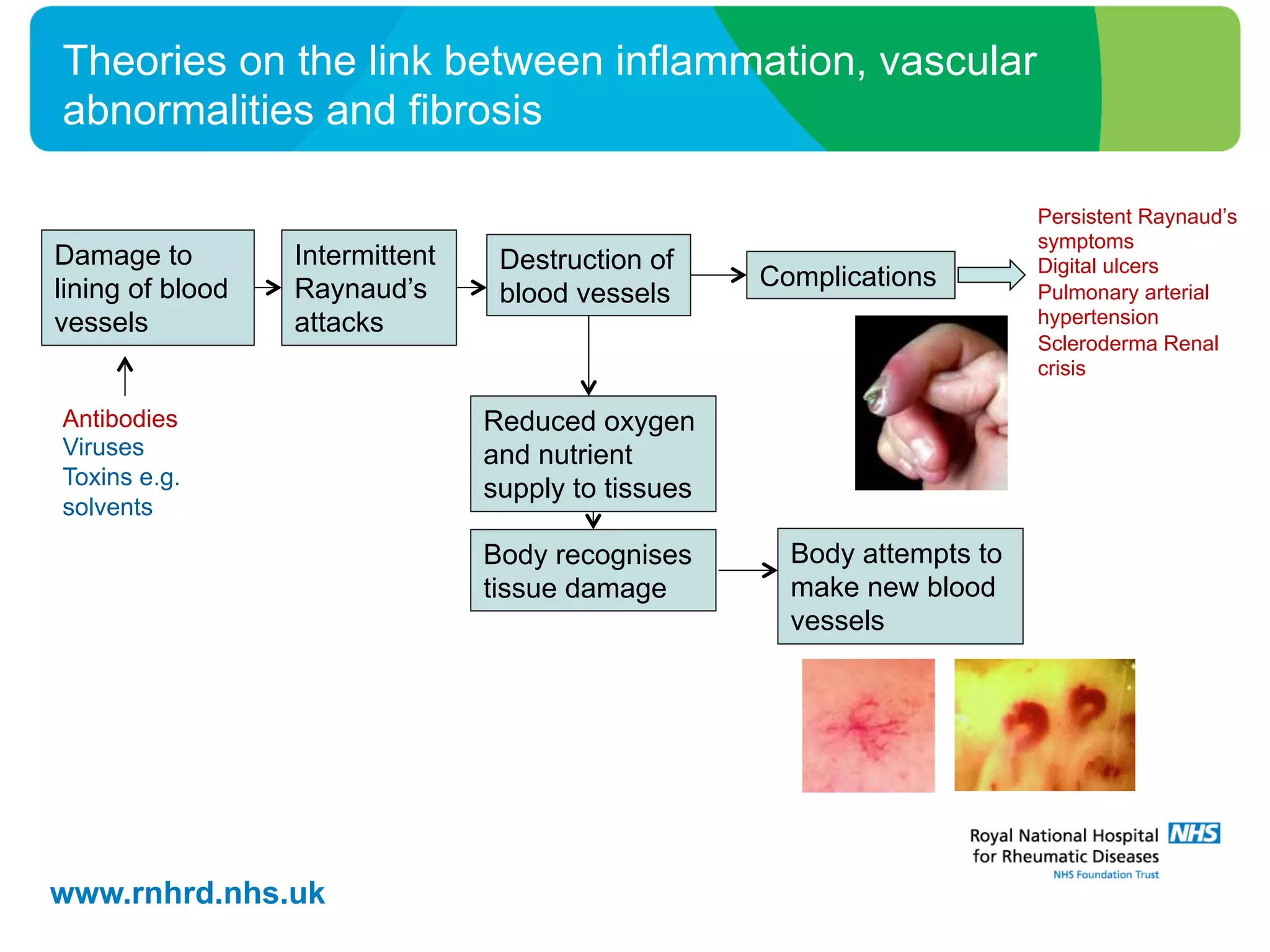 www.rnhrd.nhs.uk
Theories on the link between inflammation, vascular
abnormalities and fibrosis
Damage to
lining of blood
vessels
Intermittent
Raynaud’s
attacks
Body recognises
tissue damage
Complications
Destruction of
blood vessels
Reduced oxygen
and nutrient
supply to tissues
Antibodies
Viruses
Toxins e.g.
solvents
Persistent Raynaud’s
symptoms
Digital ulcers
Pulmonary arterial
hypertension
Scleroderma Renal
crisis
Body attempts to
make new blood
vessels
 