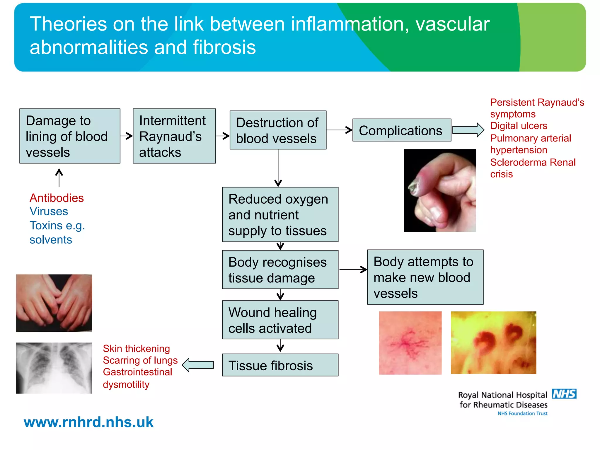 www.rnhrd.nhs.uk
Theories on the link between inflammation, vascular
abnormalities and fibrosis
Damage to
lining of blood
vessels
Tissue fibrosis
Intermittent
Raynaud’s
attacks
Body recognises
tissue damage
Wound healing
cells activated
Complications
Destruction of
blood vessels
Reduced oxygen
and nutrient
supply to tissues
Antibodies
Viruses
Toxins e.g.
solvents
Persistent Raynaud’s
symptoms
Digital ulcers
Pulmonary arterial
hypertension
Scleroderma Renal
crisis
Skin thickening
Scarring of lungs
Gastrointestinal
dysmotility
Body attempts to
make new blood
vessels
 