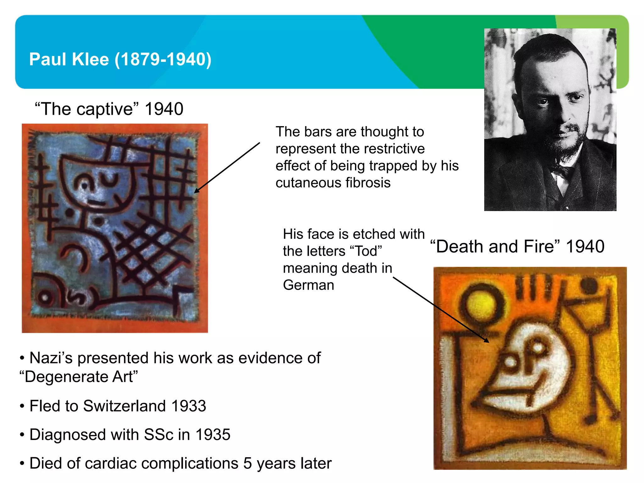 “The captive” 1940
• Nazi’s presented his work as evidence of
“Degenerate Art”
• Fled to Switzerland 1933
• Diagnosed with SSc in 1935
• Died of cardiac complications 5 years later
Paul Klee (1879-1940)
“Death and Fire” 1940
The bars are thought to
represent the restrictive
effect of being trapped by his
cutaneous fibrosis
His face is etched with
the letters “Tod”
meaning death in
German
 