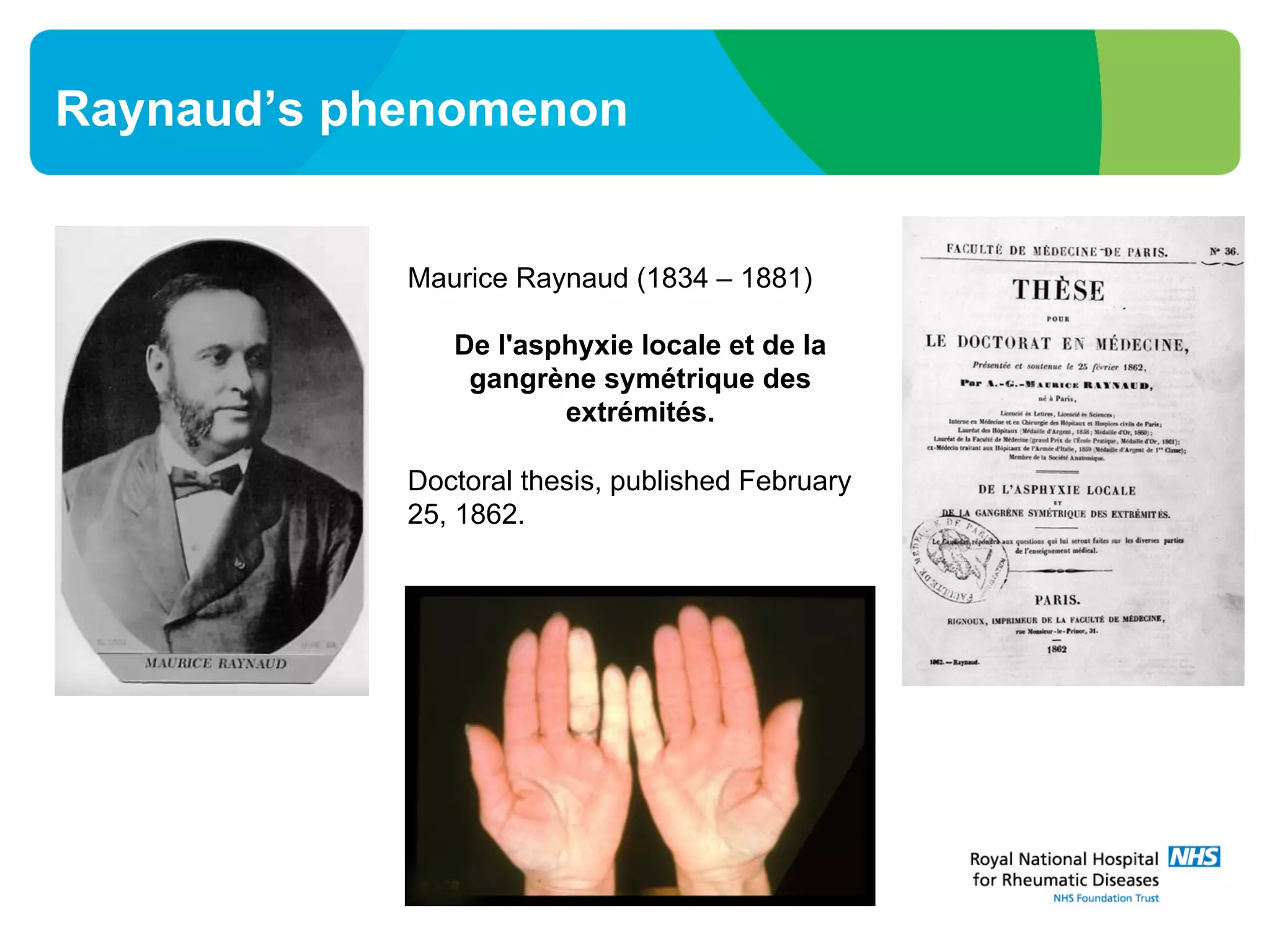 Raynaud’s phenomenon
Maurice Raynaud (1834 – 1881)
De l'asphyxie locale et de la
gangrène symétrique des
extrémités.
Doctoral thesis, published February
25, 1862.
 