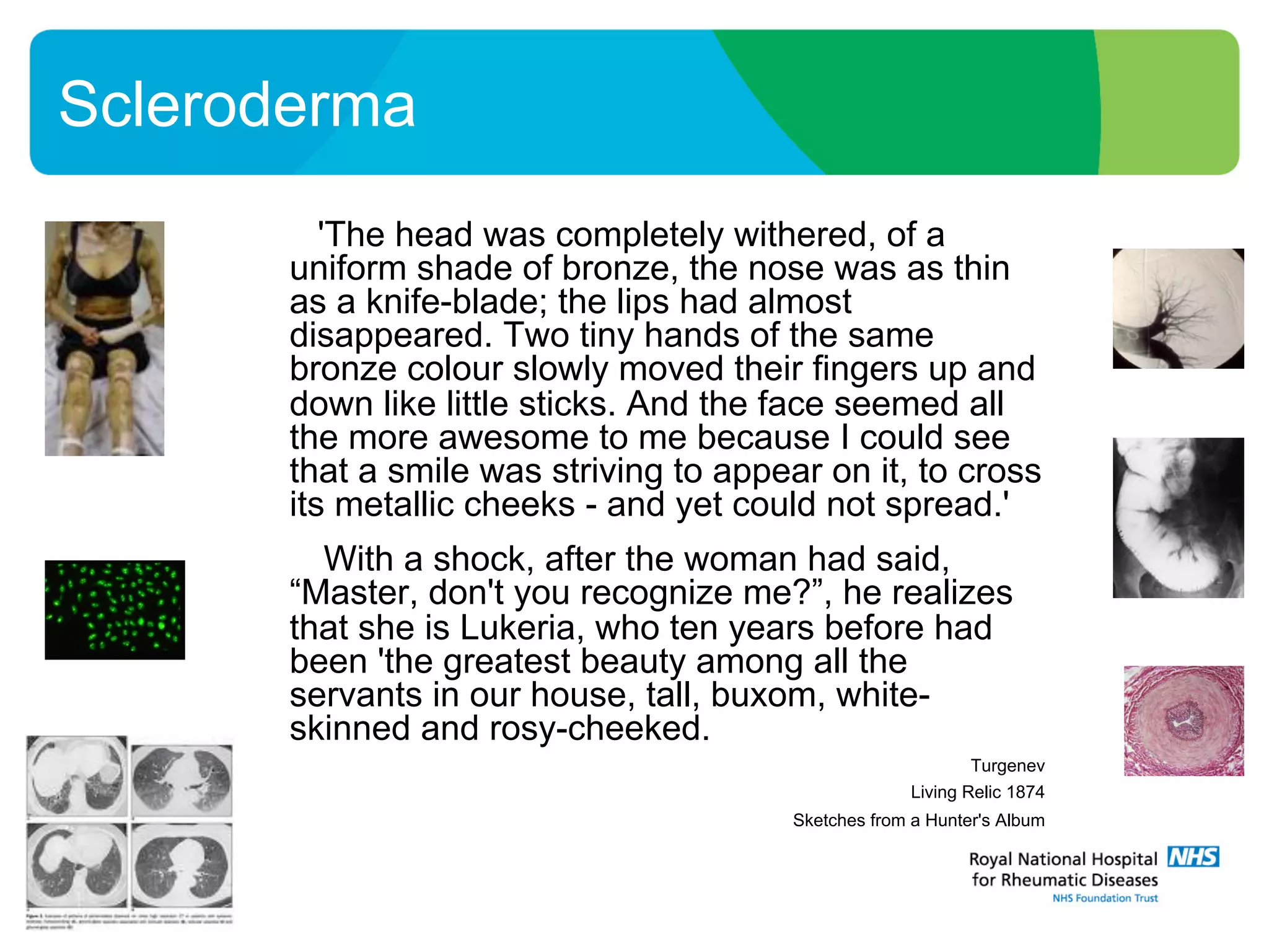 'The head was completely withered, of a
uniform shade of bronze, the nose was as thin
as a knife-blade; the lips had almost
disappeared. Two tiny hands of the same
bronze colour slowly moved their fingers up and
down like little sticks. And the face seemed all
the more awesome to me because I could see
that a smile was striving to appear on it, to cross
its metallic cheeks - and yet could not spread.'
With a shock, after the woman had said,
“Master, don't you recognize me?”, he realizes
that she is Lukeria, who ten years before had
been 'the greatest beauty among all the
servants in our house, tall, buxom, white-
skinned and rosy-cheeked.
Turgenev
Living Relic 1874
Sketches from a Hunter's Album
Scleroderma
 