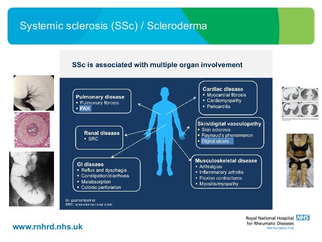 What is scleroderma? What is Raynaud's?