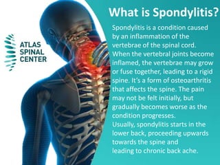 Spondylitis is a condition caused
by an inflammation of the
vertebrae of the spinal cord.
When the vertebral joints become
inflamed, the vertebrae may grow
or fuse together, leading to a rigid
spine. It’s a form of osteoarthritis
that affects the spine. The pain
may not be felt initially, but
gradually becomes worse as the
condition progresses.
Usually, spondylitis starts in the
lower back, proceeding upwards
towards the spine and
leading to chronic back ache.
What is Spondylitis?
 