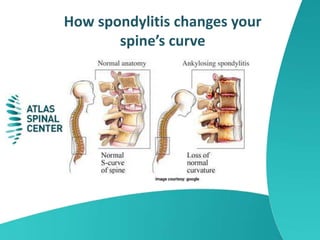 How spondylitis changes your
spine’s curve
 