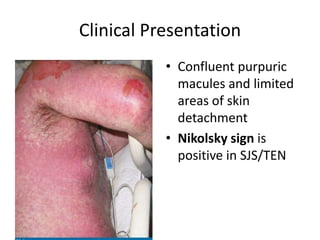 Clinical Presentation
• Confluent purpuric
macules and limited
areas of skin
detachment
• Nikolsky sign is
positive in SJS/TEN
 