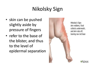 Nikolsky Sign
• skin can be pushed
slightly aside by
pressure of fingers
• refer to the base of
the blister, and thus
to the level of
epidermal separation
 